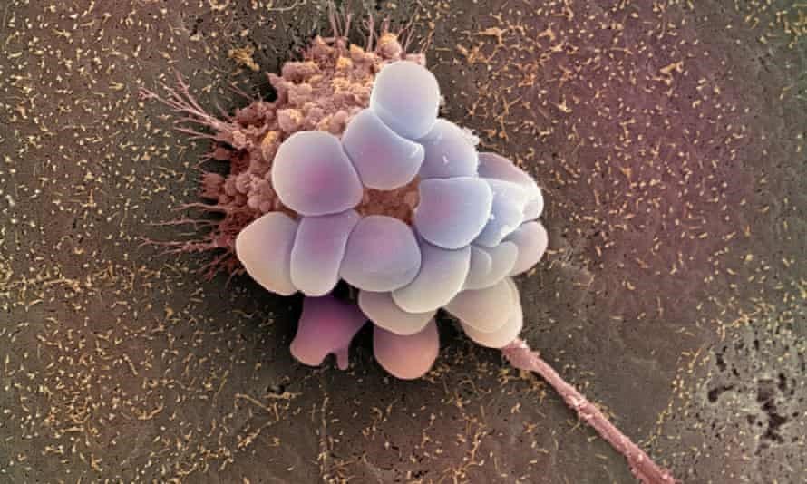 每年進行卵巢癌篩檢不能挽救生命？